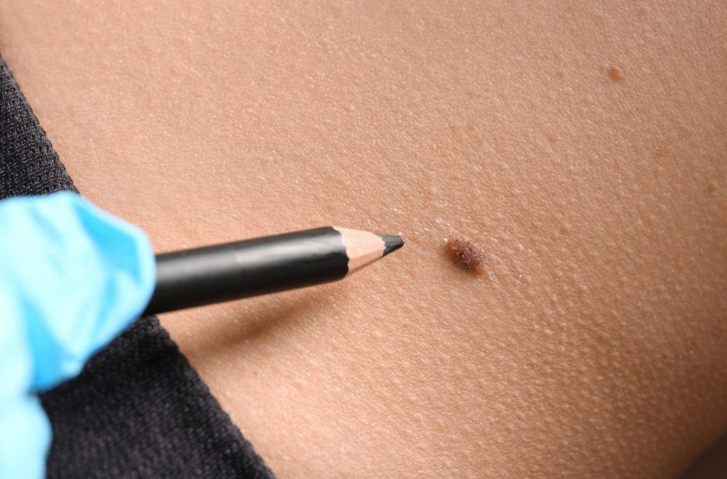 Huidkankerscreening