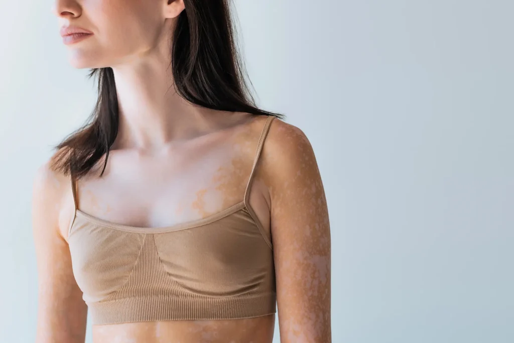 Pigmentvlekkenbehandeling